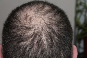 AGAは男性型脱毛症、生え際や頭頂部が薄くなること