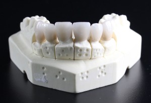 人工歯による治療